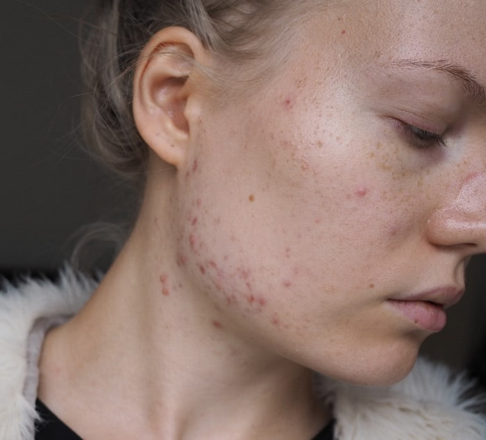 Acne