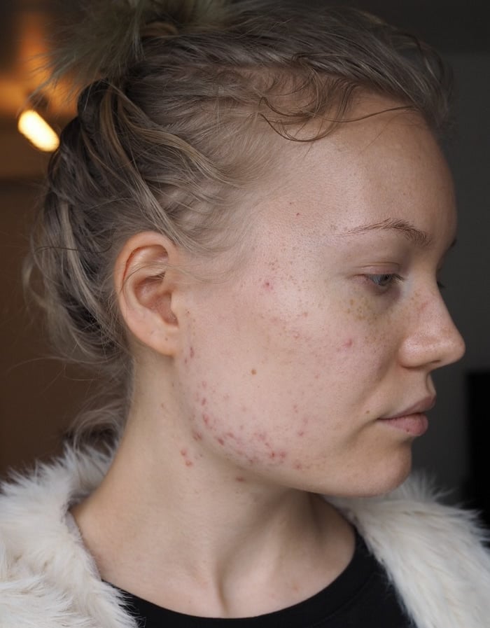 acne blogger