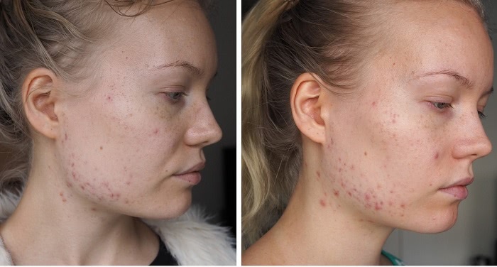 apocyclin adult acne progress