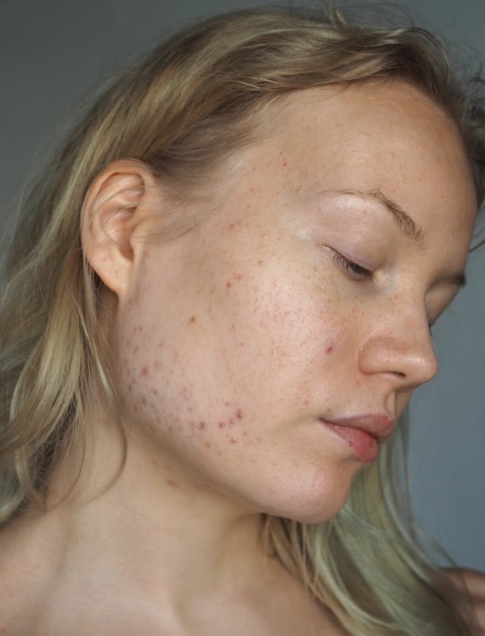 acne antibiotics progress