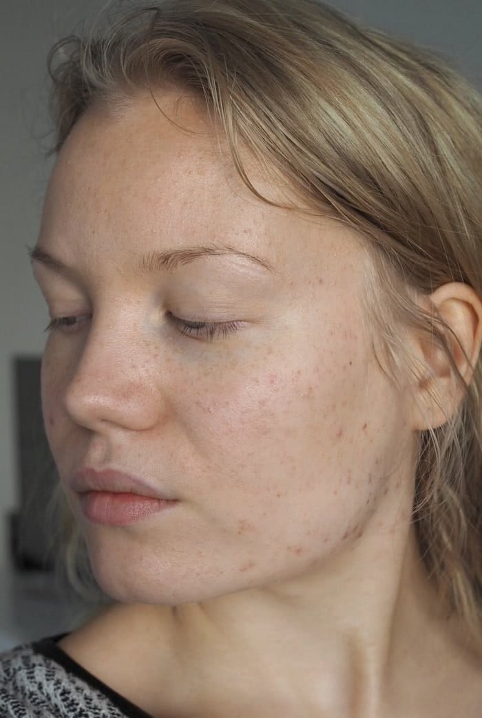 adult acne my progress