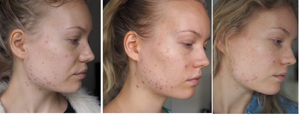 apocyclin adult acne progress