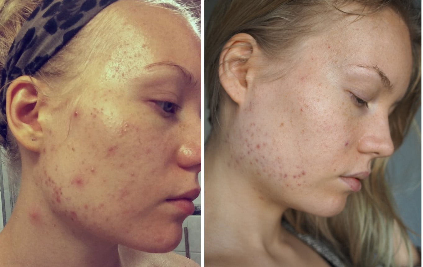 blogger acne progress