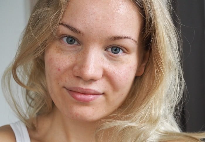 acne apocyclin