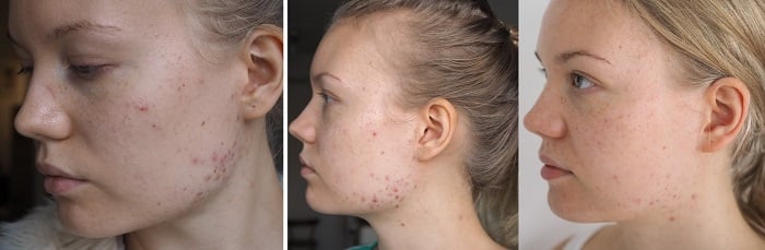 acne progress apocyclin