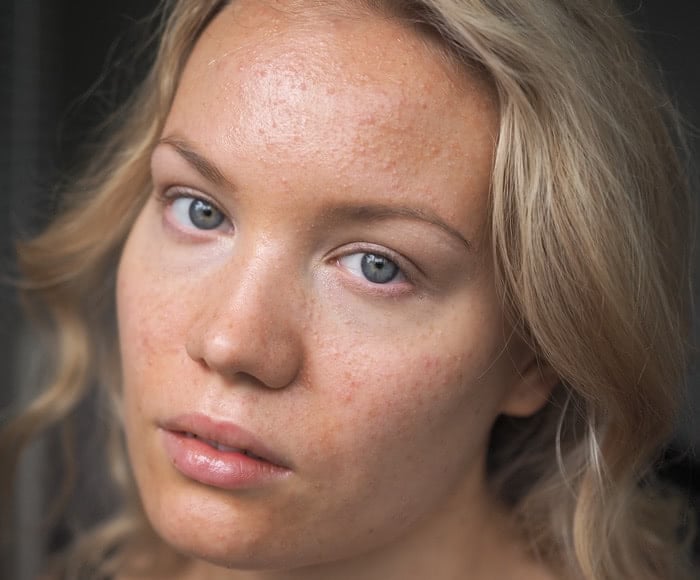 acne skin progress photo