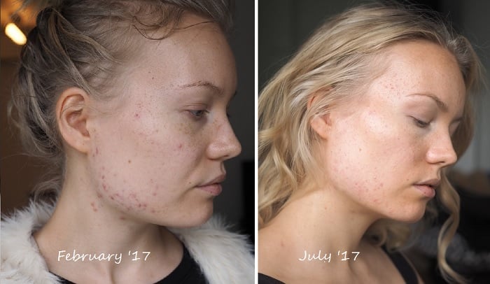 acne progress from february to july antibiotics