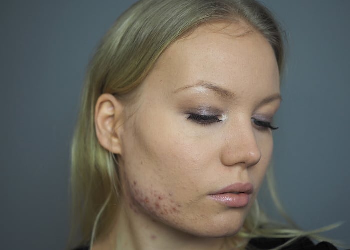 acne confidence makeup