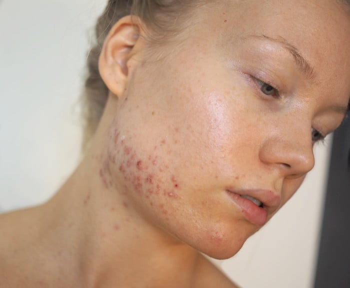 hormonal acne blog