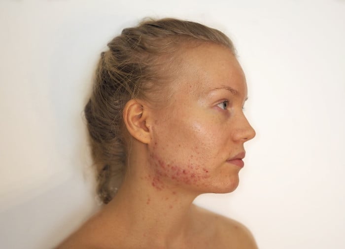 acne hormonal acne my experience