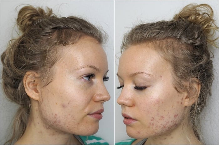 acne scars