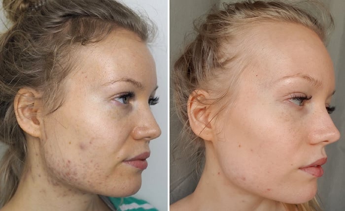 acne before after