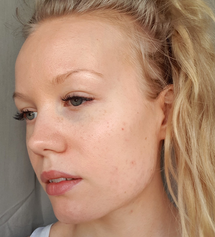 skin after acne