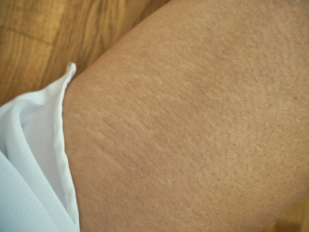 Stretch marks are just skin