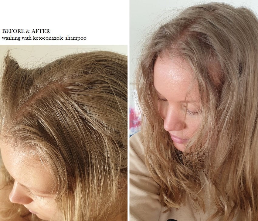 Se insekter Ananiver Store Scalp problems, seborrheic dermatitis & the curly girl method - Charlotta  Eve