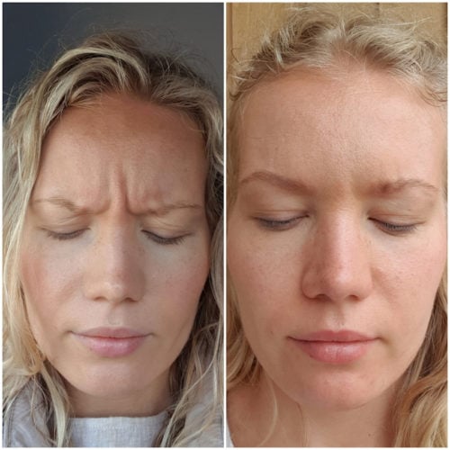 Botox for headaches and migraines? Charlotta Eve